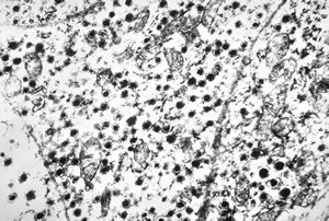 F,44y. | carcinoid - lung F,44y. | carcinoid - lung